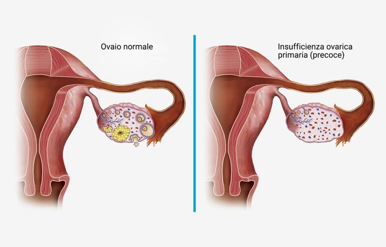Insufficienza Ovarica Precoce YourElab